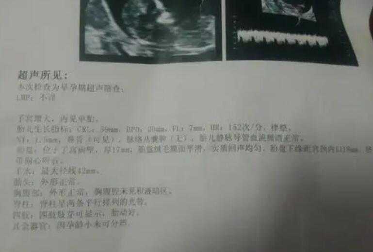天津高龄助孕机构 天津武警特色医学中心医院推荐理由 ‘b超机器上面有什么字